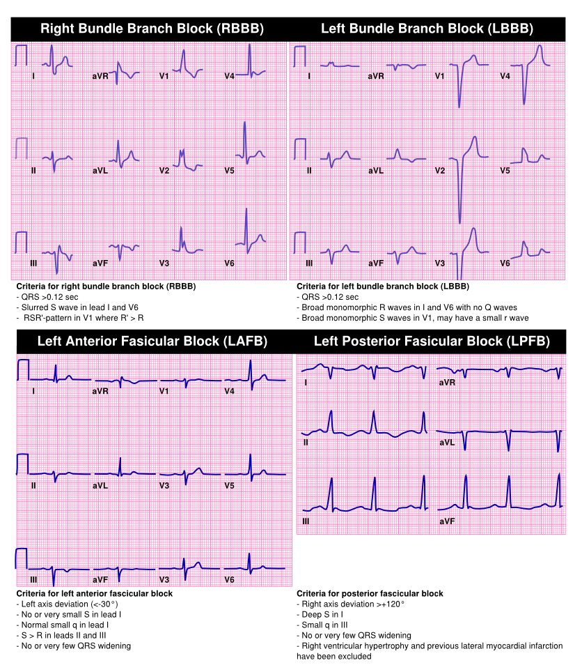 Intraventricular Conduction.svg