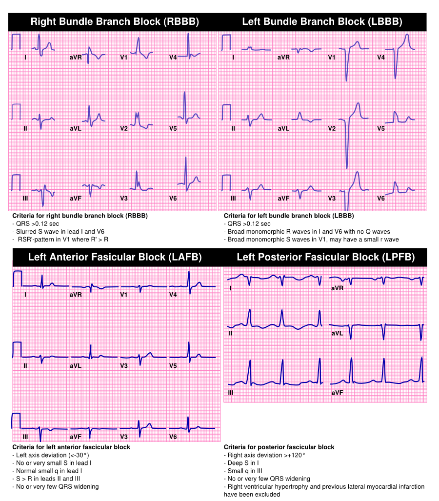 Bradycardia Textbook of Cardiology