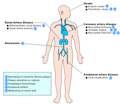 Pathogenesis Of Atherosclerosis Flow Chart