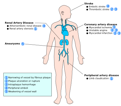 Atherosclerosis damage.svg