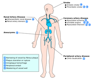 Figure 11 - Complications of atherosclerosis.png