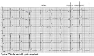 ShortQT syndrome patient.png
