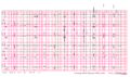 Brugada syndrome type2 example1.png