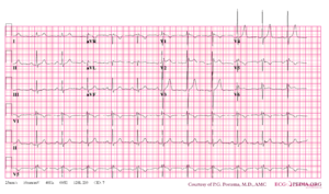 Brugada syndrome type2 example1.png
