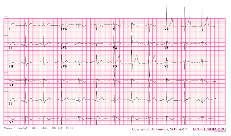 File:Brugada syndrome type2 example1.png